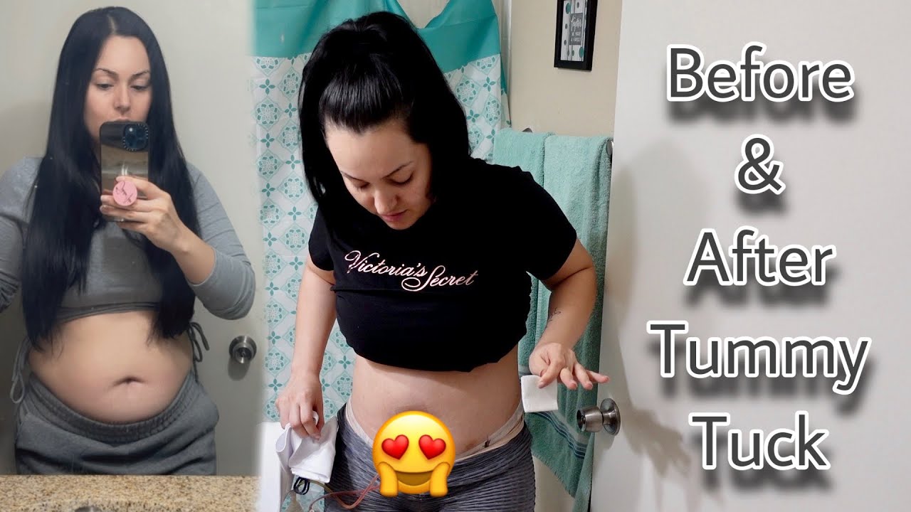 One Week Post Op Tummy Tuck Update/ Before & After 