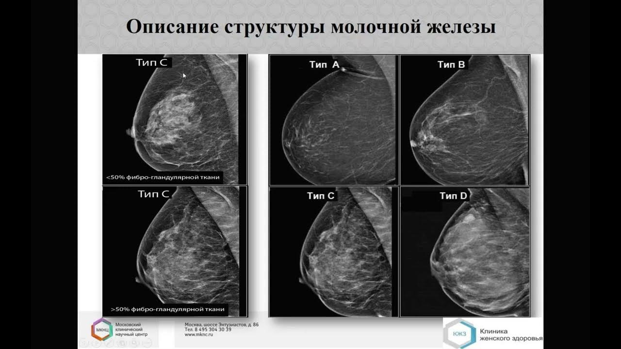 Категории маммографии. Bi rads 3 дополнительно обследование. Bi-rads 4a в молочной железе. Категории оценки bi-rads. Системы rads в онкологии.