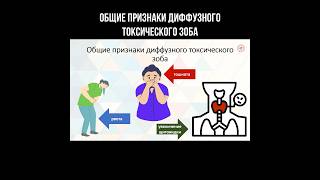 Общие признаки диффузного токсического зоба #щитовидка #зоб #эндокринолог #щитовиднаяжелеза