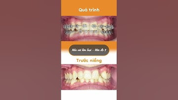 Hành trình LỘT XÁC nhờ niềng răng của Ngọc Hoàng