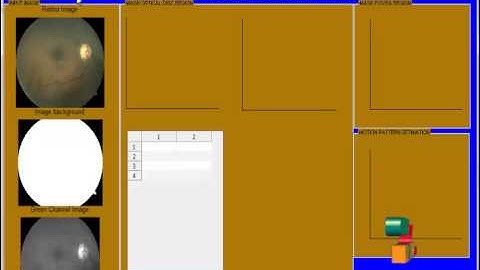Final Year Projects  | Automatic Assessment of Macular Edema From Color Retinal Images