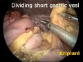 Laparoscopic Heller's Cardiomyotomy with Dor Patch for Achalasia Cardia