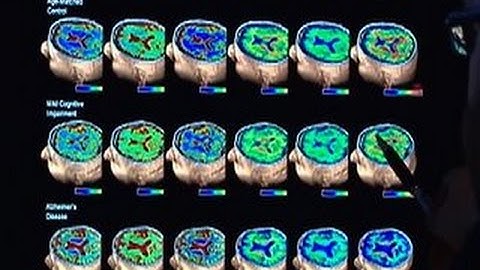 New protein found in brains of Alzheimer