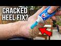 DIY Cracked Heel Treatment You Won't Believe Works