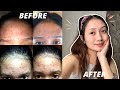 HOW I FINALLY GOT RID OF MY ACNE & SCARS (fast and affordable skincare) 2020 PHILIPPINES