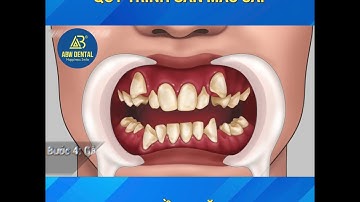 QUY TRÌNH GẮN MẮC CÀI | Thế Giới Nha Khoa AB