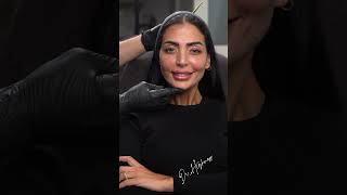 Dr. Firas Hamdan is combining #Sculptra & #Fillers To Get This #Transformation. #beauty #dubai #fyp