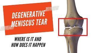 Degenerative meniscus tear: What is it and how does it happen?