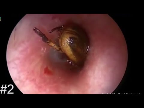 bot fly removal tsetse fly larvae removal www pixshark images galleries with a bite bot fly removal tsetse fly larvae removal www pixshark images galleries with a bite