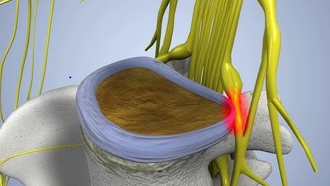 What are the Most Common Symptoms of a Pinched Nerve / Dr Mandell