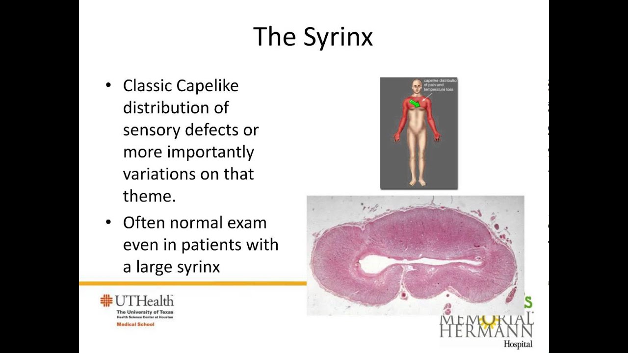Syringomyelia Cape Like