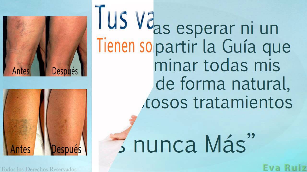 como eliminar varices de manera natural