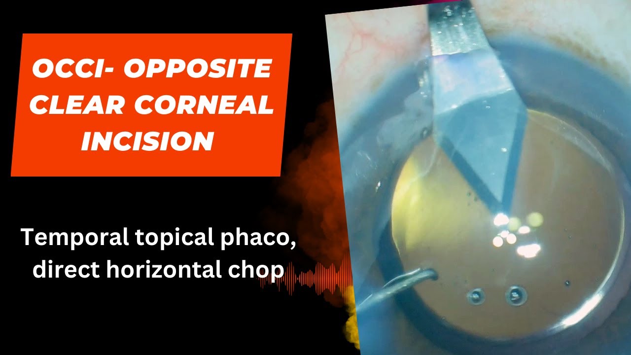 Case series 48. OCCI, Opposite clear corneal incision, temporal topical ...