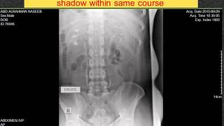 CASE 64 IVP Delayed faint persistent left nephrogram  Dr AHMED ESAWY
