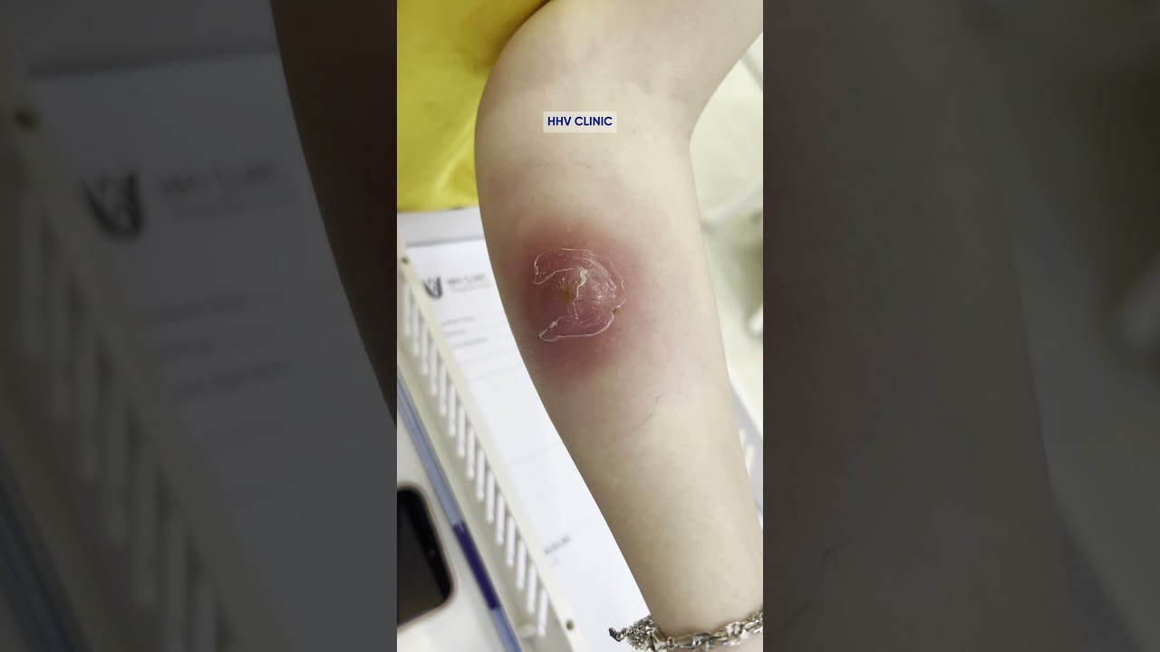 Mụn áp xe sưng viêm đau nhức ở cánh tay.