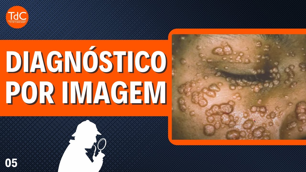 Thumbnail - "Múltiplas pápulas UMBILICADAS" l Desafio TdC 05
