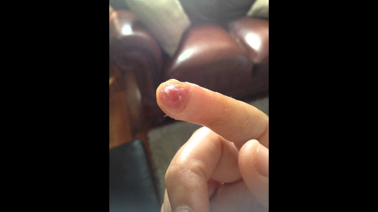 wound grow over make to a how skin growing cut knife a a back skin with finger's My after