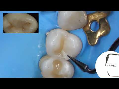 Aesthetic Direct Composite Restorations on molars | Deppeler | Dr. Brambilla