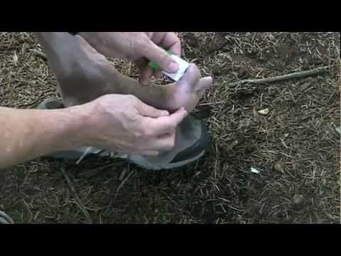 Only The Lightest, Ch 58: Ultralight Backpacking, How to Prevent and Care for Blisters