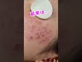 しみ そばかす 美容皮膚科なら1回でどこまで綺麗になる しみ そばかす 美容皮膚科なら1回でどこまで綺麗になる