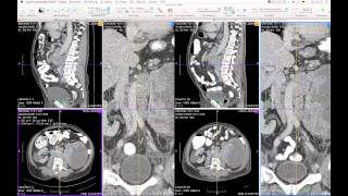 FusionSync Prototype: Follow-up CT Study Examination