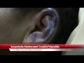 Levamisole Adulterated Cocaine Vasculitis