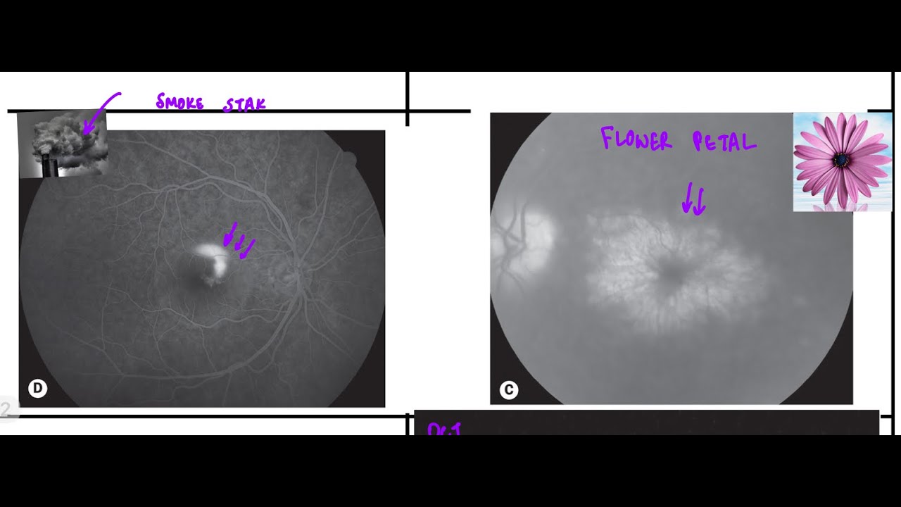 Central Serous Retinopathy vs Cystoid Macular Edema for NEETPG|NEXT|INICET|FMGE By Dr SAMEER SHAIKH