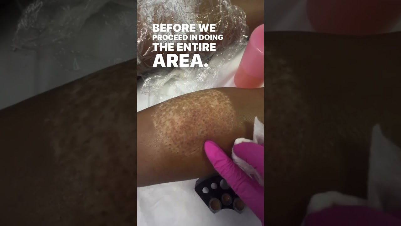 LASER TATTOO REMOVAL AND CAMOUFLAGE! 