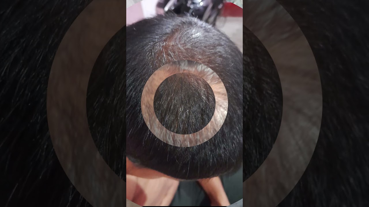 Genetic hair loss regrowth by leech therapy | leech therapy for hair regrowth | r