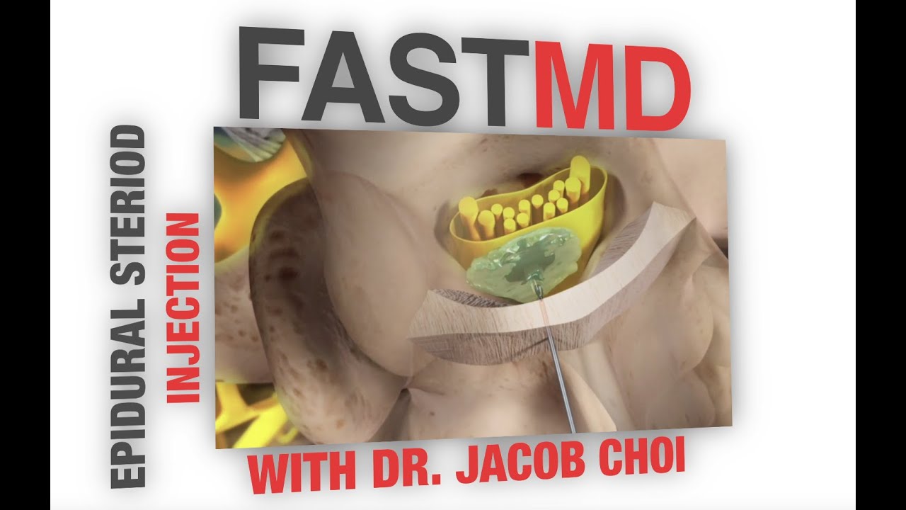 Jacob Groh Injection Dr. Jacob Choi: Epidural Steroid Injection - YouTube