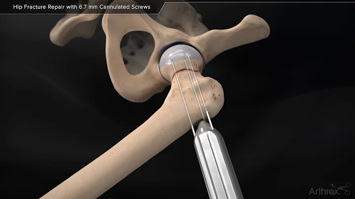 Hip Fracture Repair with 6 7 mm Cannulated Screws