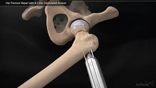 Hip Fracture Repair With 6 7 Mm Cannulated Screws