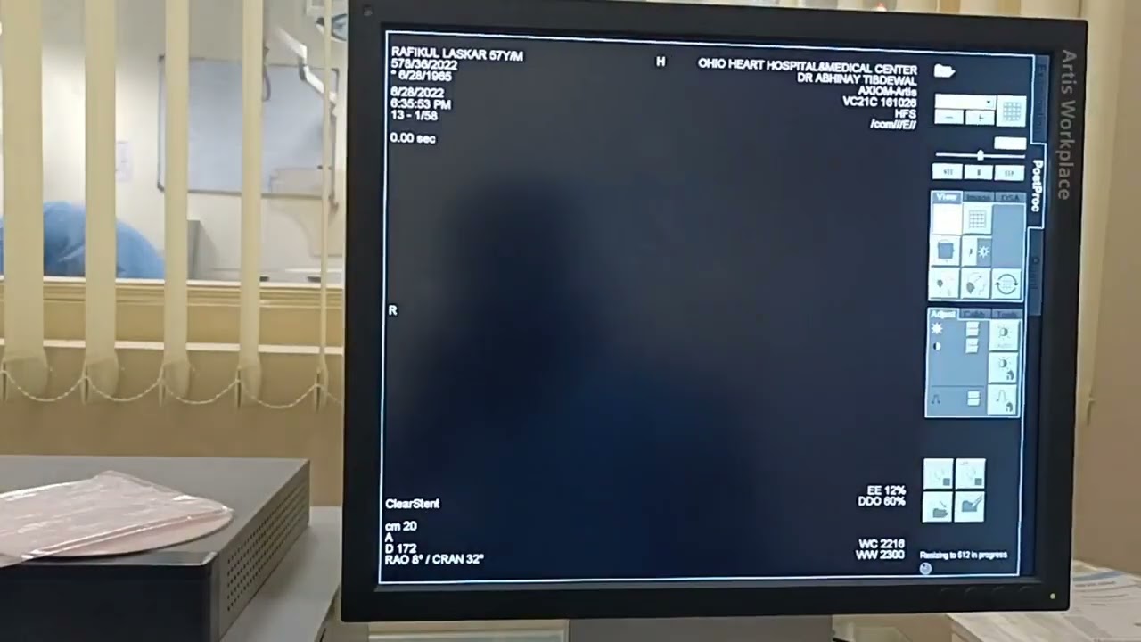 pt name Rafikul Laskar 57y/M ( PTCA TO LAD )