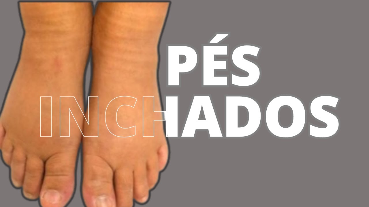 COMO ALIVIAR E CURAR PÉS INCHADOS DE FORMA RAPIDA . - YouTube