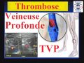 Thrombose veineuse profonde symptmes traitement recommandations prvention de lembolie pulmonaire