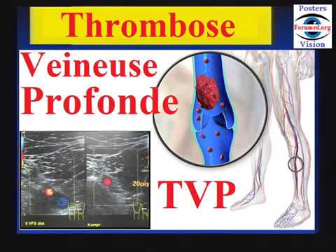 Thrombose veineuse profonde symptômes traitement recommandations Prévention de l'embolie pulmonaire.
