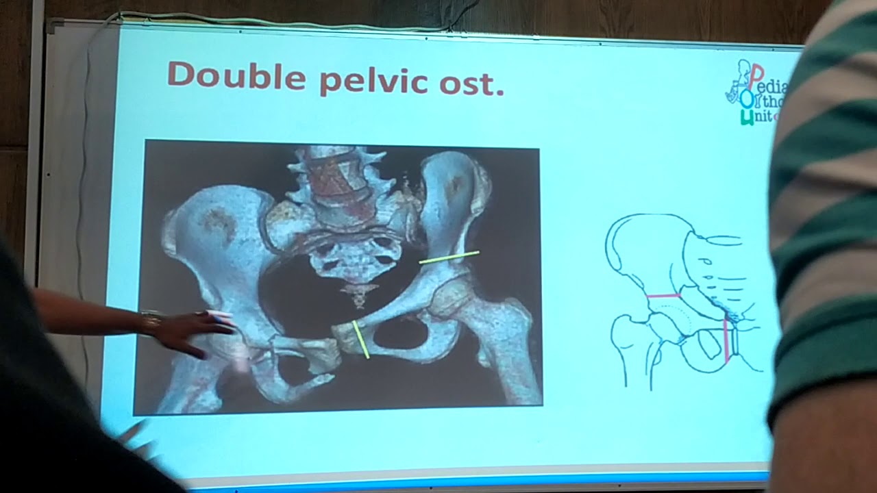 Pelvic osteotomy , Part1 YouTube