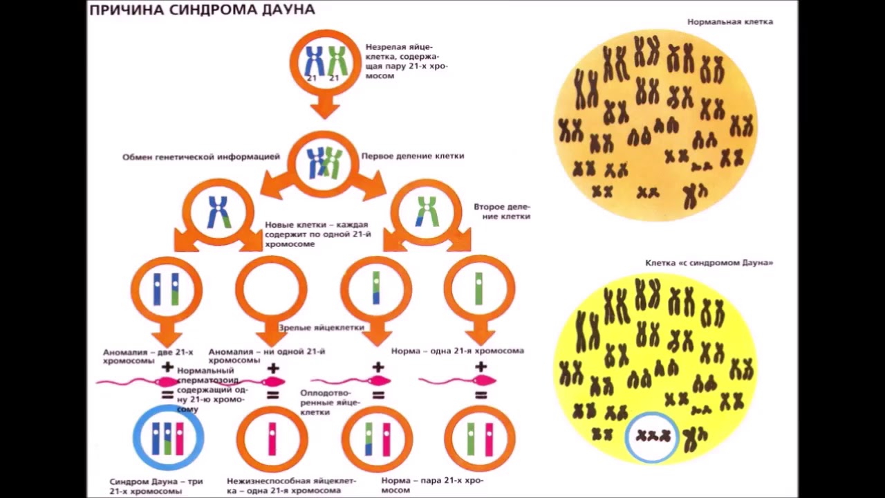 Ген дауна. Механизм развития синдрома Дауна. Механизм формирования синдрома Дауна. Болезнь Дауна набор хромосом. Синдром Дауна схема хромосом.