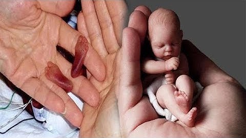 ప్రపంచంలోనే అతిచిన్న పాప పుట్టింది..|World Tiniest baby Born Hyderabad |world breaking news today