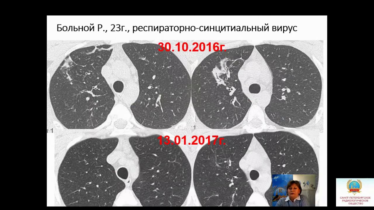 Сперанская А.А."Острые интерстициальные пневмонии вирусного генеза: что должен увидеть рентгенолог""