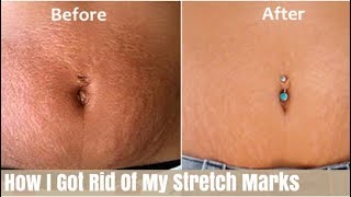 How To Get Rid Of Stretch Marks | This REALLY WORKED | Victoria Victoria screenshot 2