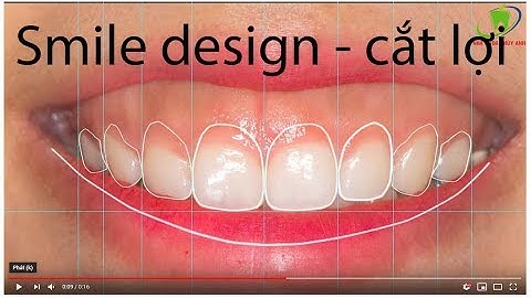 ✅ Smile Design - Bản thiết kế trước khi làm phẫu thuật cắt lợi, có hạ xương ổ Răng tại Thái Nguyên 💞