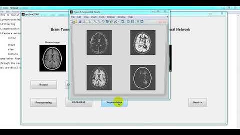 Brain Tumor Segmentation And Classification using DWT,Gabour Wavelet And GLCM