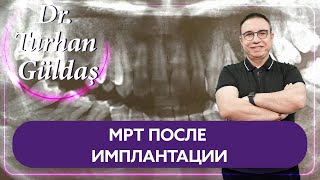 Можно ли делать МРТ после имплантации?
