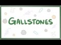 Gallstones (cholelithiasis) - causes, symptoms, diagnosis, treatment & pathology
