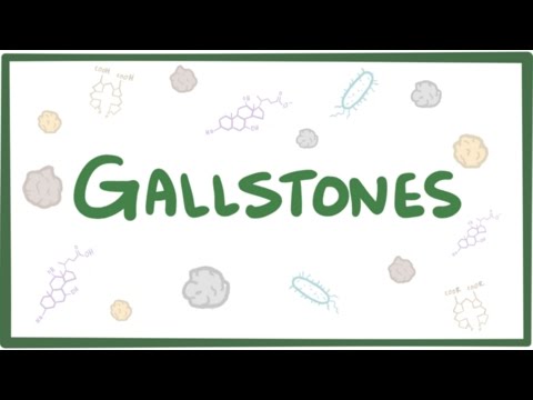 Gallstones (cholelithiasis) - causes, symptoms, diagnosis, treatment & pathology