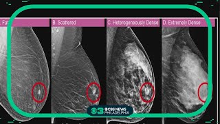 Breast cancer survivor raising awareness on the danger and mystery behind dense breasts