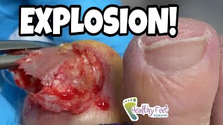 BIG TOE READY TO EXPLODE!  WATCH WHAT HAPPENS NEXT!