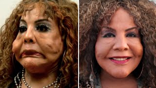 10 Times Plastic Surgery Went Horribly Wrong