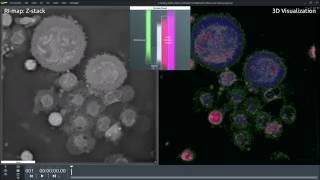 Circulating Tumor Cells (A549) detection with 3D microscope